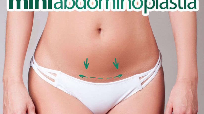 Mini Abdominoplastia